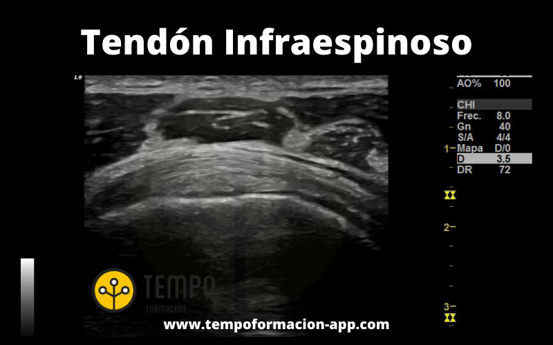 Tendon Infra.png